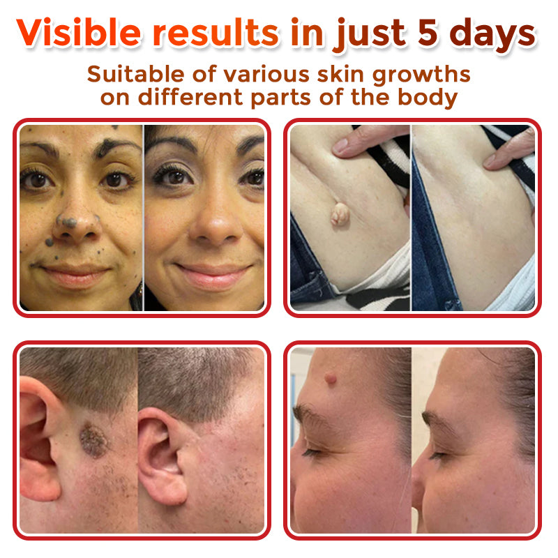 𝐓𝐋𝐎𝐏𝐀® 𝐌𝐢𝐜𝐫𝐨𝐧𝐞𝐞𝐝𝐥𝐞 𝐁𝐨𝐭𝐚𝐧𝐢𝐜 𝐒𝐤𝐢𝐧 𝐓𝐚𝐠 𝐑𝐞𝐦𝐨𝐯𝐚𝐥 𝐏𝐚𝐭𝐜𝐡  🇺🇸（Firming skin care丨wart removal丨no injection required丨effective in 5 days）🍁💖