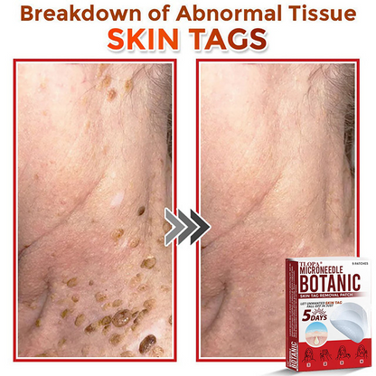𝐓𝐋𝐎𝐏𝐀® 𝐌𝐢𝐜𝐫𝐨𝐧𝐞𝐞𝐝𝐥𝐞 𝐁𝐨𝐭𝐚𝐧𝐢𝐜 𝐒𝐤𝐢𝐧 𝐓𝐚𝐠 𝐑𝐞𝐦𝐨𝐯𝐚𝐥 𝐏𝐚𝐭𝐜𝐡  🇺🇸（Firming skin care丨wart removal丨no injection required丨effective in 5 days）🍁💖