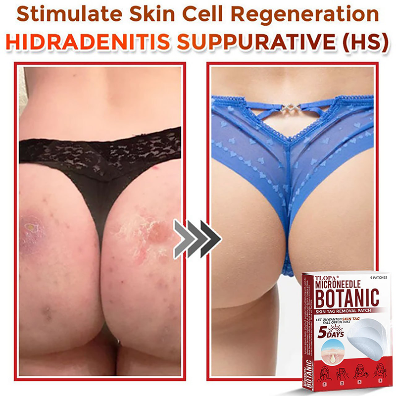 𝐓𝐋𝐎𝐏𝐀® 𝐌𝐢𝐜𝐫𝐨𝐧𝐞𝐞𝐝𝐥𝐞 𝐁𝐨𝐭𝐚𝐧𝐢𝐜 𝐒𝐤𝐢𝐧 𝐓𝐚𝐠 𝐑𝐞𝐦𝐨𝐯𝐚𝐥 𝐏𝐚𝐭𝐜𝐡  🇺🇸（Firming skin care丨wart removal丨no injection required丨effective in 5 days）🍁💖