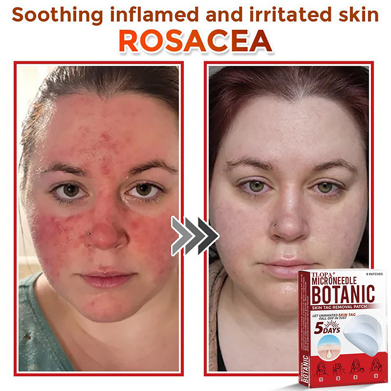 𝐓𝐋𝐎𝐏𝐀® 𝐌𝐢𝐜𝐫𝐨𝐧𝐞𝐞𝐝𝐥𝐞 𝐁𝐨𝐭𝐚𝐧𝐢𝐜 𝐒𝐤𝐢𝐧 𝐓𝐚𝐠 𝐑𝐞𝐦𝐨𝐯𝐚𝐥 𝐏𝐚𝐭𝐜𝐡  🇺🇸（Firming skin care丨wart removal丨no injection required丨effective in 5 days）🍁💖