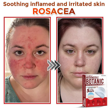 𝐓𝐋𝐎𝐏𝐀® 𝐌𝐢𝐜𝐫𝐨𝐧𝐞𝐞𝐝𝐥𝐞 𝐁𝐨𝐭𝐚𝐧𝐢𝐜 𝐒𝐤𝐢𝐧 𝐓𝐚𝐠 𝐑𝐞𝐦𝐨𝐯𝐚𝐥 𝐏𝐚𝐭𝐜𝐡  🇺🇸（Firming skin care丨wart removal丨no injection required丨effective in 5 days）🍁💖