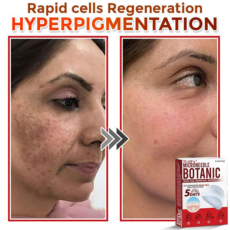 𝐓𝐋𝐎𝐏𝐀® 𝐌𝐢𝐜𝐫𝐨𝐧𝐞𝐞𝐝𝐥𝐞 𝐁𝐨𝐭𝐚𝐧𝐢𝐜 𝐒𝐤𝐢𝐧 𝐓𝐚𝐠 𝐑𝐞𝐦𝐨𝐯𝐚𝐥 𝐏𝐚𝐭𝐜𝐡  🇺🇸（Firming skin care丨wart removal丨no injection required丨effective in 5 days）🍁💖