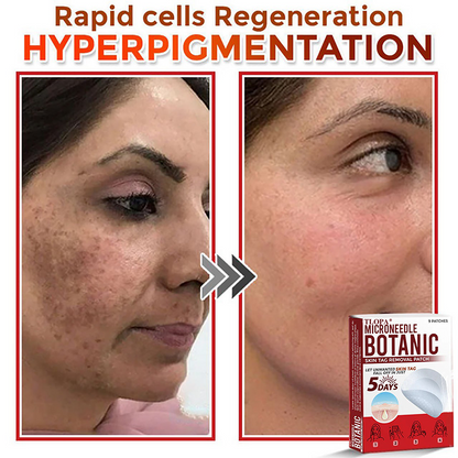 𝐓𝐋𝐎𝐏𝐀® 𝐌𝐢𝐜𝐫𝐨𝐧𝐞𝐞𝐝𝐥𝐞 𝐁𝐨𝐭𝐚𝐧𝐢𝐜 𝐒𝐤𝐢𝐧 𝐓𝐚𝐠 𝐑𝐞𝐦𝐨𝐯𝐚𝐥 𝐏𝐚𝐭𝐜𝐡  🇺🇸（Firming skin care丨wart removal丨no injection required丨effective in 5 days）🍁💖