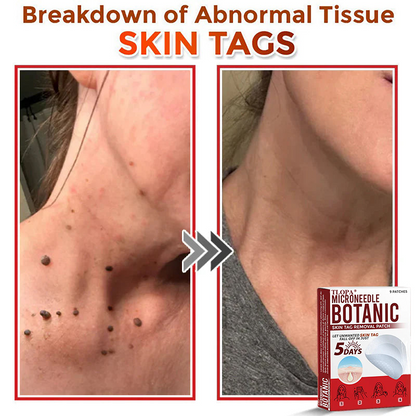 𝐓𝐋𝐎𝐏𝐀® 𝐌𝐢𝐜𝐫𝐨𝐧𝐞𝐞𝐝𝐥𝐞 𝐁𝐨𝐭𝐚𝐧𝐢𝐜 𝐒𝐤𝐢𝐧 𝐓𝐚𝐠 𝐑𝐞𝐦𝐨𝐯𝐚𝐥 𝐏𝐚𝐭𝐜𝐡  🇺🇸（Firming skin care丨wart removal丨no injection required丨effective in 5 days）🍁💖