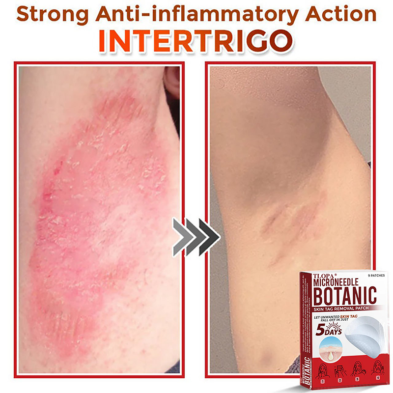 𝐓𝐋𝐎𝐏𝐀® 𝐌𝐢𝐜𝐫𝐨𝐧𝐞𝐞𝐝𝐥𝐞 𝐁𝐨𝐭𝐚𝐧𝐢𝐜 𝐒𝐤𝐢𝐧 𝐓𝐚𝐠 𝐑𝐞𝐦𝐨𝐯𝐚𝐥 𝐏𝐚𝐭𝐜𝐡  🇺🇸（Firming skin care丨wart removal丨no injection required丨effective in 5 days）🍁💖