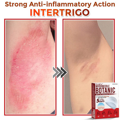 𝐓𝐋𝐎𝐏𝐀® 𝐌𝐢𝐜𝐫𝐨𝐧𝐞𝐞𝐝𝐥𝐞 𝐁𝐨𝐭𝐚𝐧𝐢𝐜 𝐒𝐤𝐢𝐧 𝐓𝐚𝐠 𝐑𝐞𝐦𝐨𝐯𝐚𝐥 𝐏𝐚𝐭𝐜𝐡  🇺🇸（Firming skin care丨wart removal丨no injection required丨effective in 5 days）🍁💖