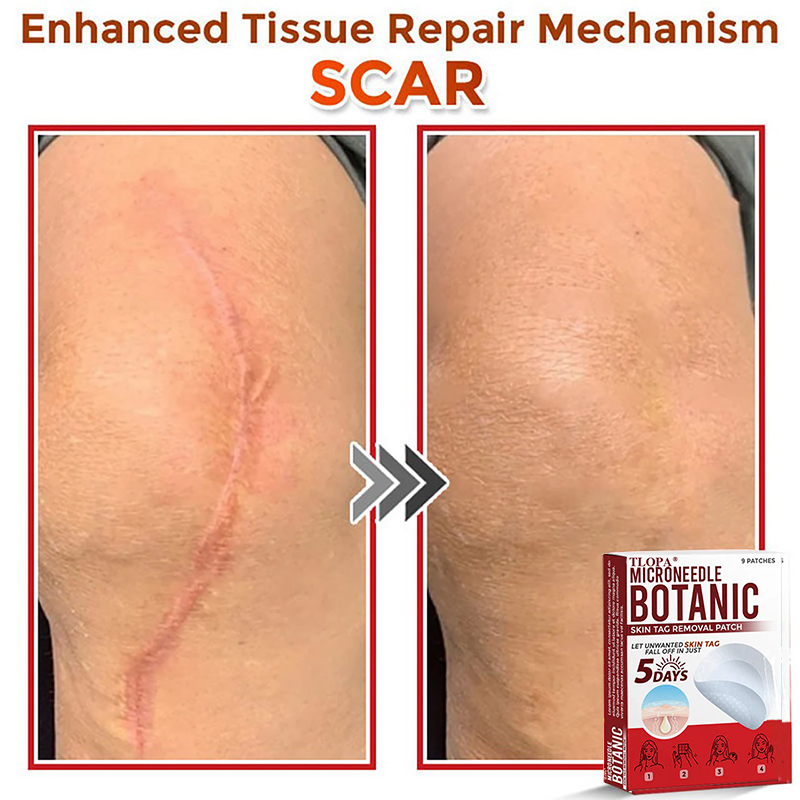 𝐓𝐋𝐎𝐏𝐀® 𝐌𝐢𝐜𝐫𝐨𝐧𝐞𝐞𝐝𝐥𝐞 𝐁𝐨𝐭𝐚𝐧𝐢𝐜 𝐒𝐤𝐢𝐧 𝐓𝐚𝐠 𝐑𝐞𝐦𝐨𝐯𝐚𝐥 𝐏𝐚𝐭𝐜𝐡  🇺🇸（Firming skin care丨wart removal丨no injection required丨effective in 5 days）🍁💖