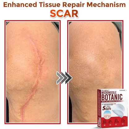 𝐓𝐋𝐎𝐏𝐀® 𝐌𝐢𝐜𝐫𝐨𝐧𝐞𝐞𝐝𝐥𝐞 𝐁𝐨𝐭𝐚𝐧𝐢𝐜 𝐒𝐤𝐢𝐧 𝐓𝐚𝐠 𝐑𝐞𝐦𝐨𝐯𝐚𝐥 𝐏𝐚𝐭𝐜𝐡  🇺🇸（Firming skin care丨wart removal丨no injection required丨effective in 5 days）🍁💖