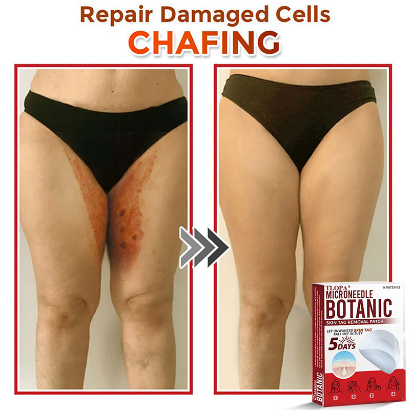 𝐓𝐋𝐎𝐏𝐀® 𝐌𝐢𝐜𝐫𝐨𝐧𝐞𝐞𝐝𝐥𝐞 𝐁𝐨𝐭𝐚𝐧𝐢𝐜 𝐒𝐤𝐢𝐧 𝐓𝐚𝐠 𝐑𝐞𝐦𝐨𝐯𝐚𝐥 𝐏𝐚𝐭𝐜𝐡  🇺🇸（Firming skin care丨wart removal丨no injection required丨effective in 5 days）🍁💖