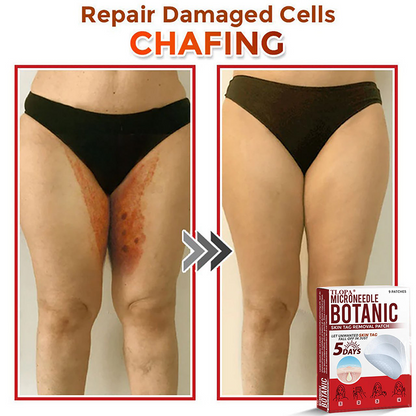 𝐓𝐋𝐎𝐏𝐀® 𝐌𝐢𝐜𝐫𝐨𝐧𝐞𝐞𝐝𝐥𝐞 𝐁𝐨𝐭𝐚𝐧𝐢𝐜 𝐒𝐤𝐢𝐧 𝐓𝐚𝐠 𝐑𝐞𝐦𝐨𝐯𝐚𝐥 𝐏𝐚𝐭𝐜𝐡  🇺🇸（Firming skin care丨wart removal丨no injection required丨effective in 5 days）🍁💖